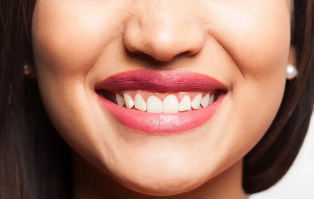 Gum Contouring in East Cobb