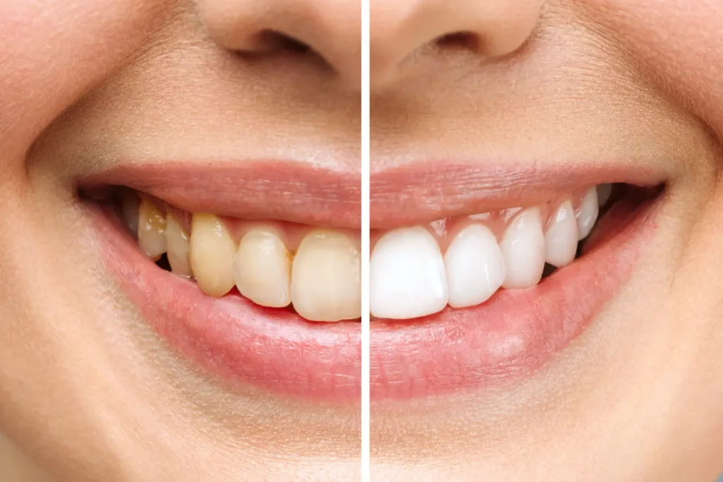 KöR Whitening