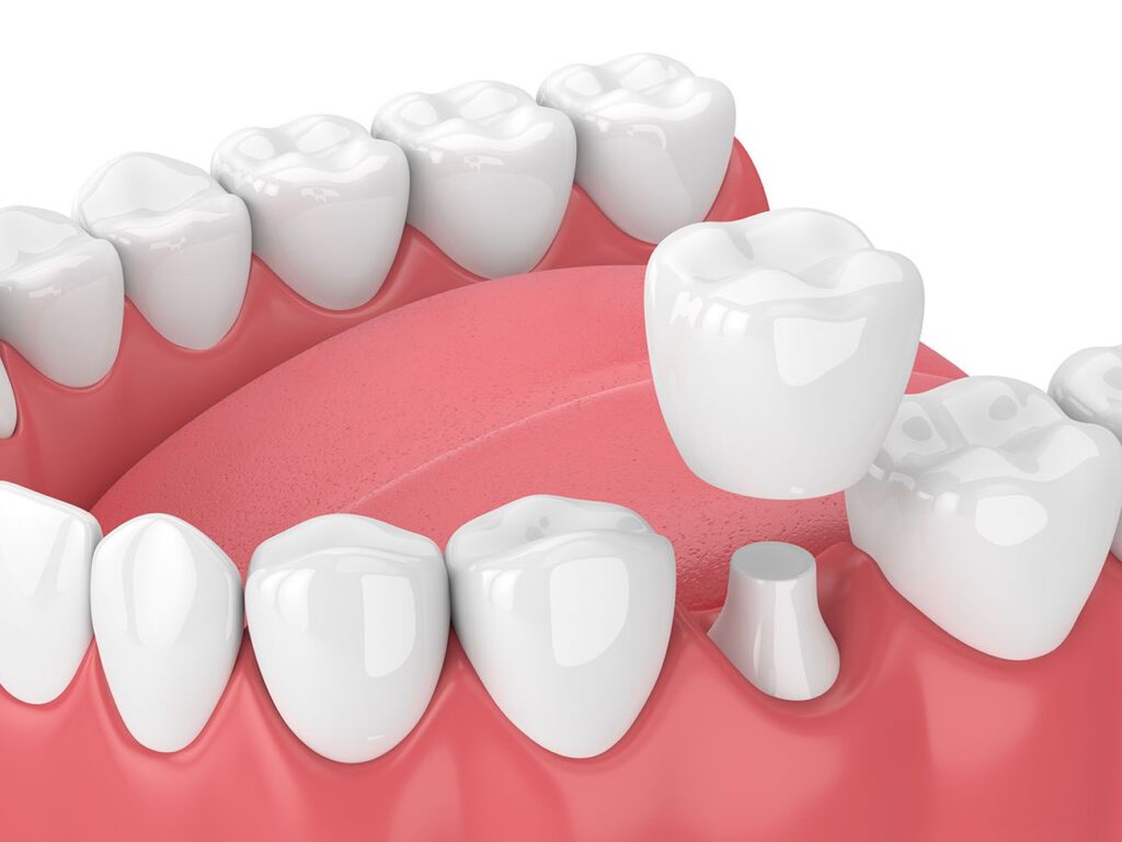 dental crown procedure East Cobb Georgia