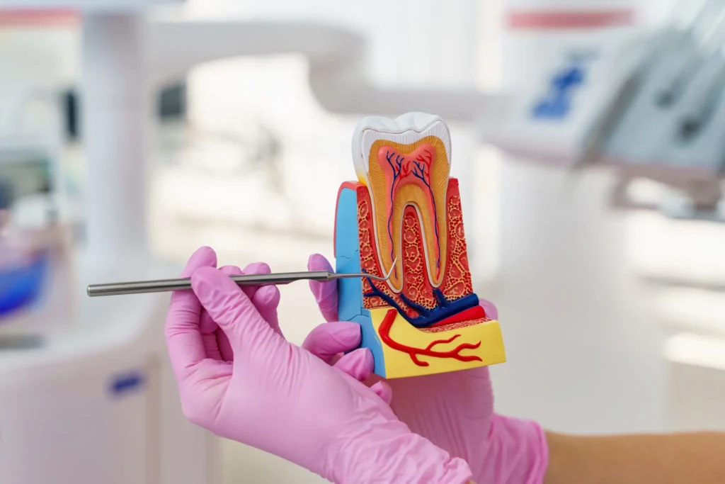 Root Canal Therapy
